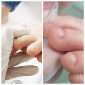 terapia kwasowa brodawek